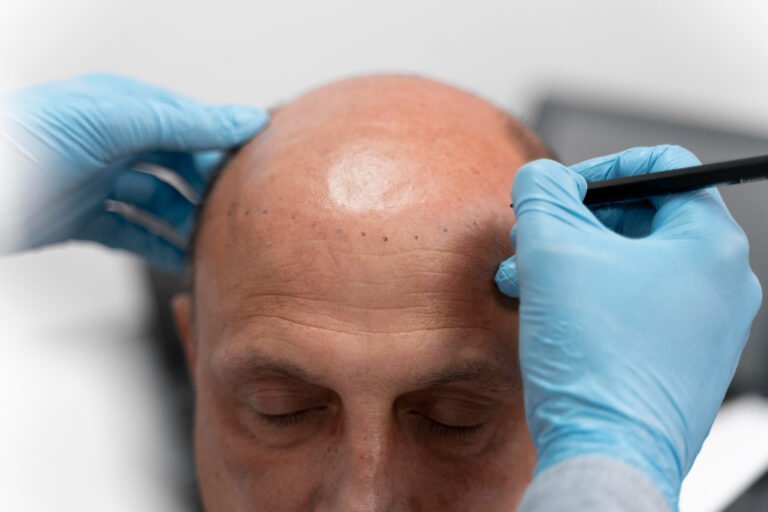 Scalp Micropigmentation